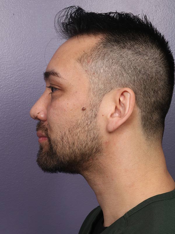 Chin & Cheek Shaping Before & After Image