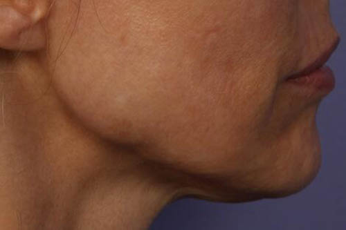 Chin & Cheek Shaping Before & After Image