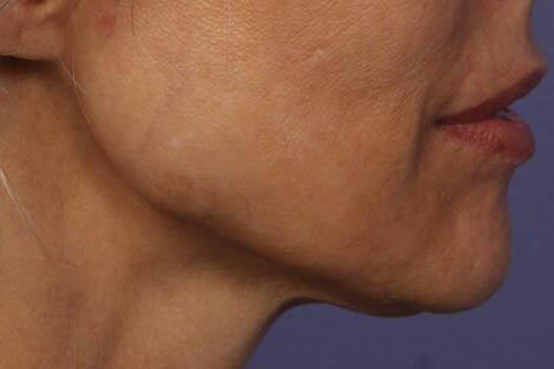 Chin & Cheek Shaping Before & After Image