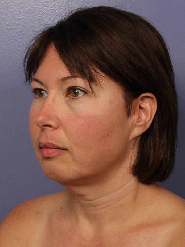 Chin & Cheek Shaping Before & After Image