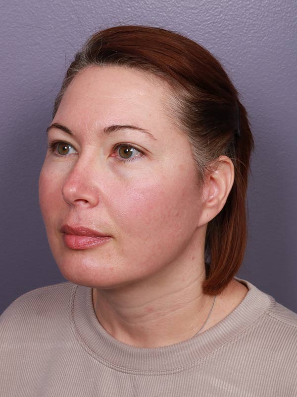 Chin & Cheek Shaping Before & After Image