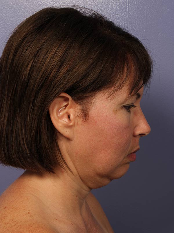 Chin & Cheek Shaping Before & After Image