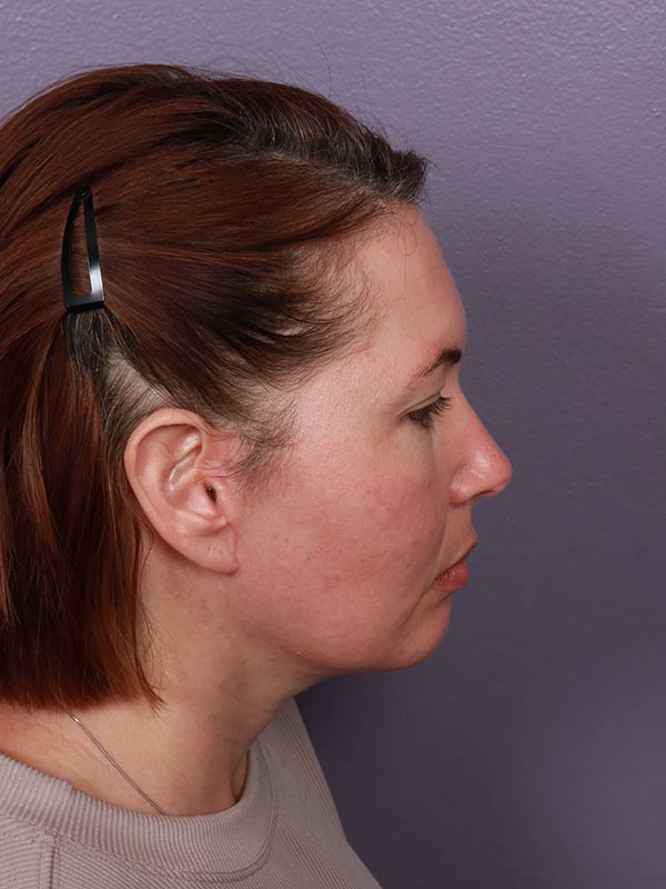 Chin & Cheek Shaping Before & After Image