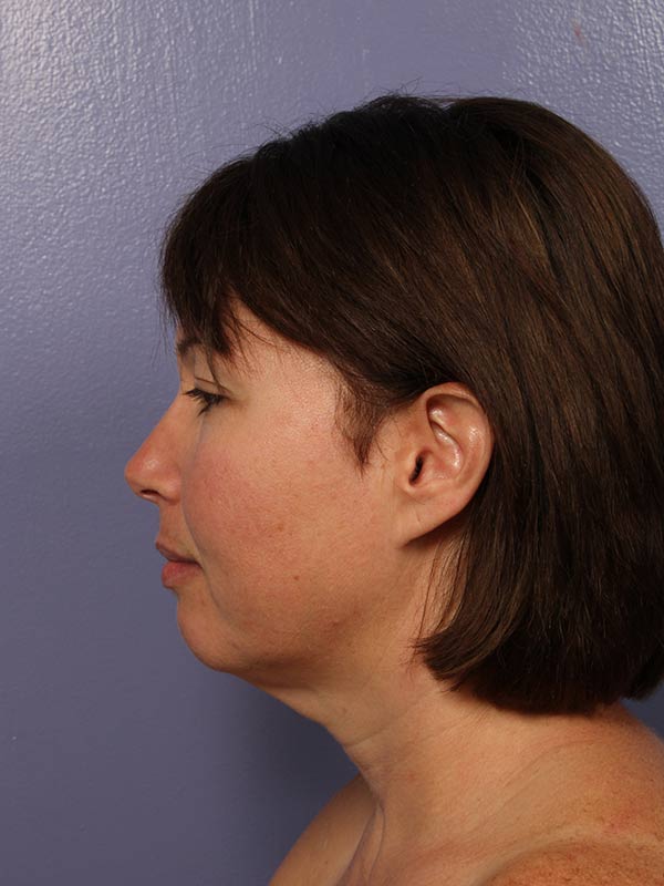 Chin & Cheek Shaping Before & After Image