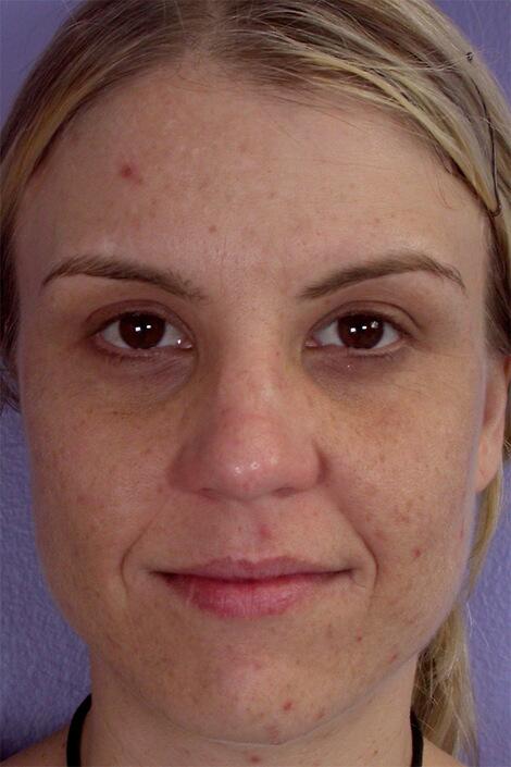 Chemical Peels Before & After Image