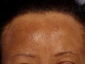 Chemical Peels Before & After Image