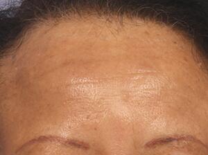 Chemical Peels Before & After Image