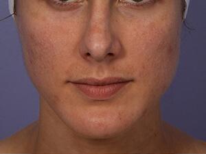 Chemical Peels Before & After Image