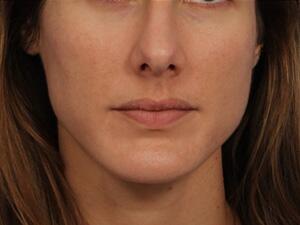 Chemical Peels Before & After Image