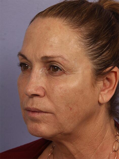 Chemical Peels Before & After Image