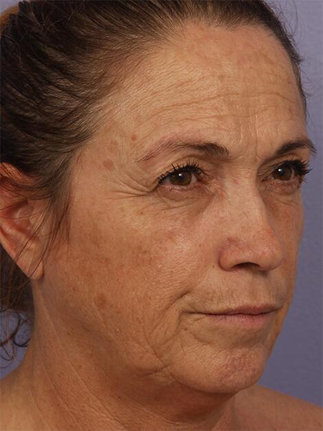 Chemical Peels Before & After Image