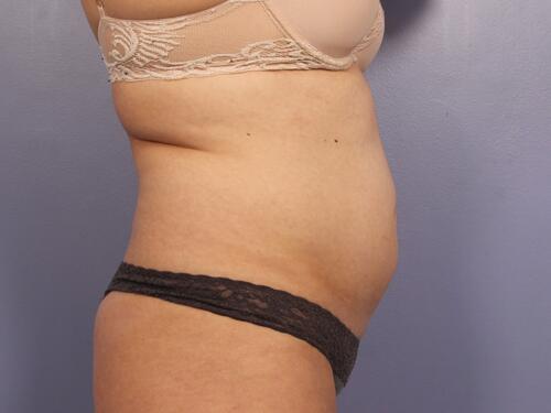 CoolSculpting Before & After Image