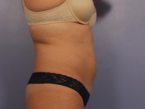 CoolSculpting Before & After Image