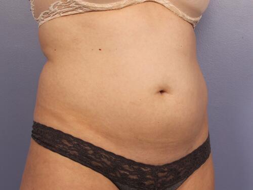 CoolSculpting Before & After Image