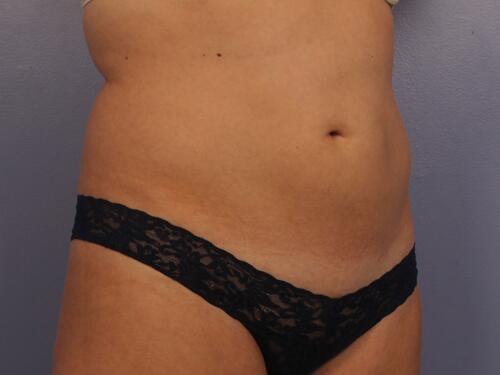 CoolSculpting Before & After Image