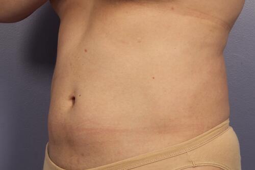 CoolSculpting Before & After Image