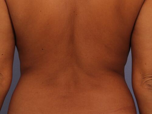 CoolSculpting Before & After Image