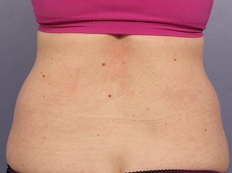 CoolSculpting Before & After Image