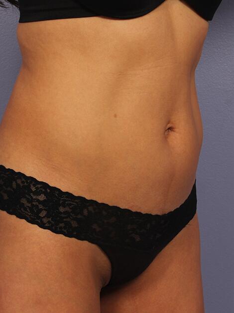 CoolSculpting Before & After Image