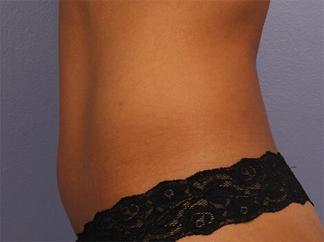 CoolSculpting Before & After Image