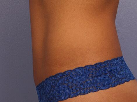 CoolSculpting Before & After Image