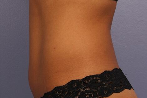 CoolSculpting Before & After Image