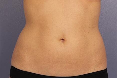 CoolSculpting Before & After Image