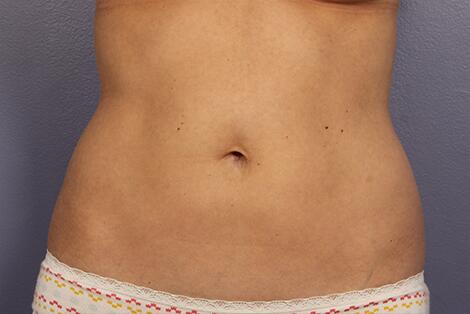 CoolSculpting Before & After Image