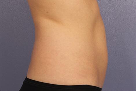 CoolSculpting Before & After Image