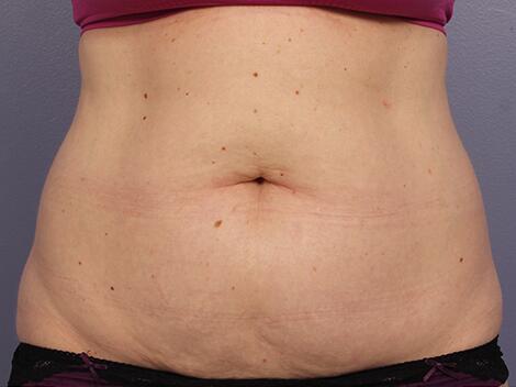 CoolSculpting Before & After Image