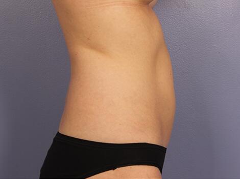 CoolSculpting Before & After Image