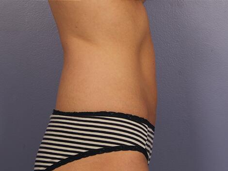 CoolSculpting Before & After Image