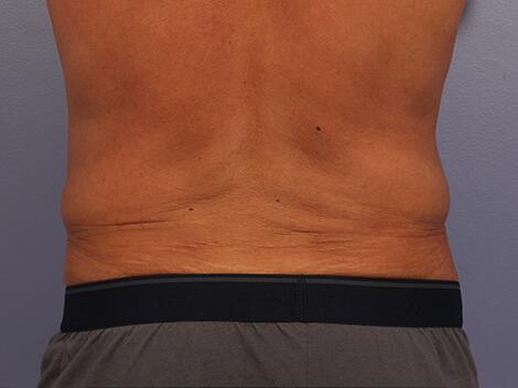 CoolSculpting Before & After Image