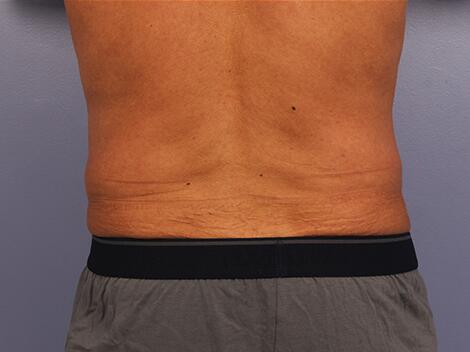 CoolSculpting Before & After Image