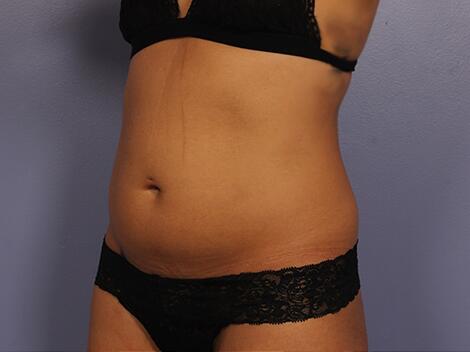 CoolSculpting Before & After Image