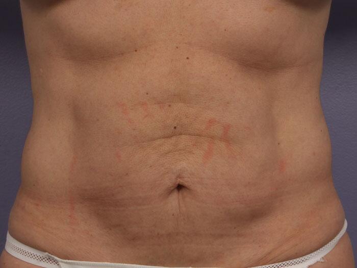 CoolSculpting Before & After Image