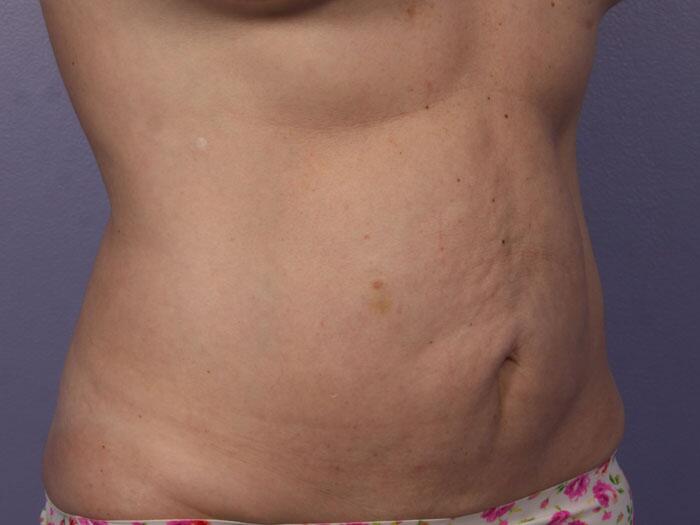 CoolSculpting Before & After Image