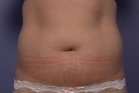 CoolSculpting Before & After Image