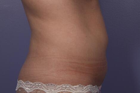 CoolSculpting Before & After Image