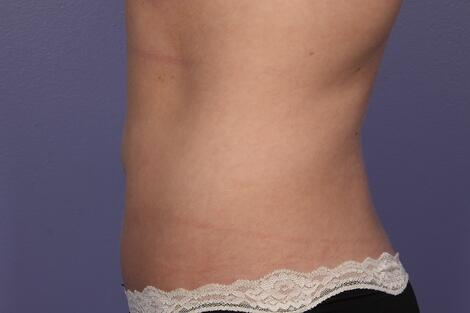 CoolSculpting Before & After Image