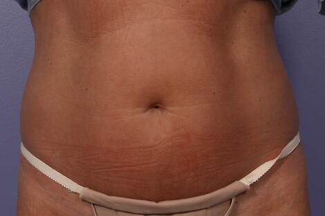 CoolSculpting Before & After Image