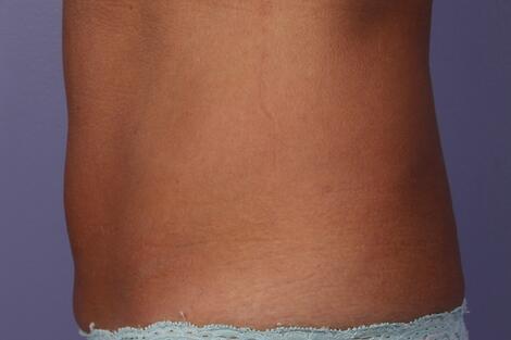 CoolSculpting Before & After Image