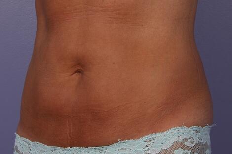 CoolSculpting Before & After Image