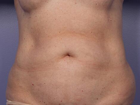 CoolSculpting Before & After Image