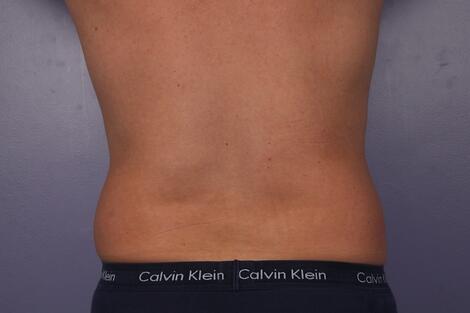 CoolSculpting Before & After Image