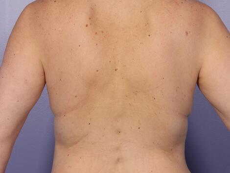 CoolSculpting Before & After Image