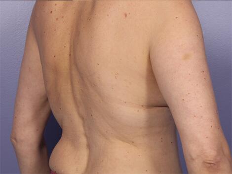 CoolSculpting Before & After Image