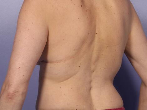 CoolSculpting Before & After Image