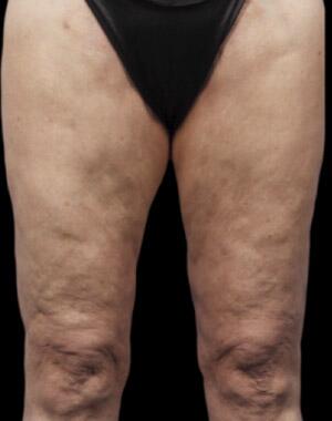 CoolSculpting Before & After Image