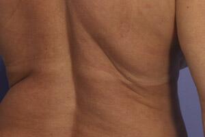 CoolSculpting Before & After Image